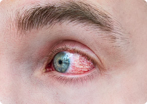 Close-up of an injured eye